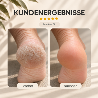 Elektrischer Hornhautentferner – Sanfte Fußpflege